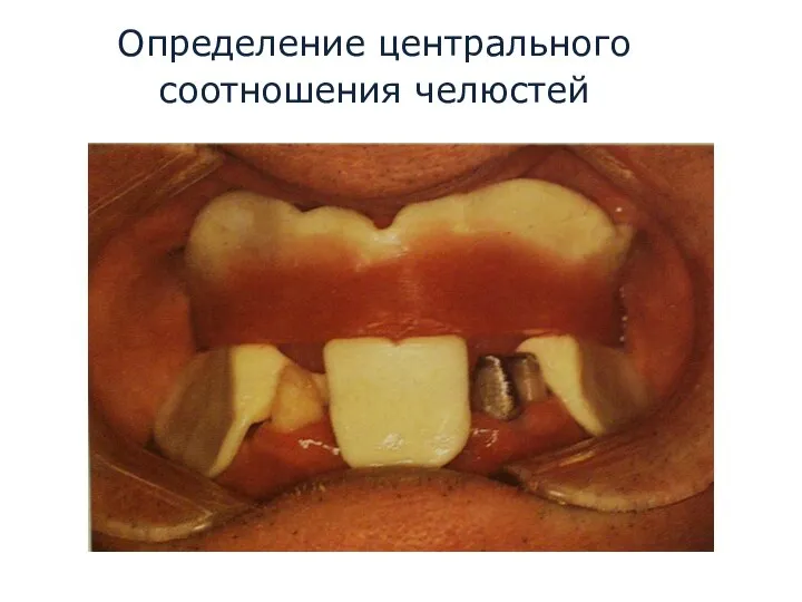 Определение центрального соотношения челюстей