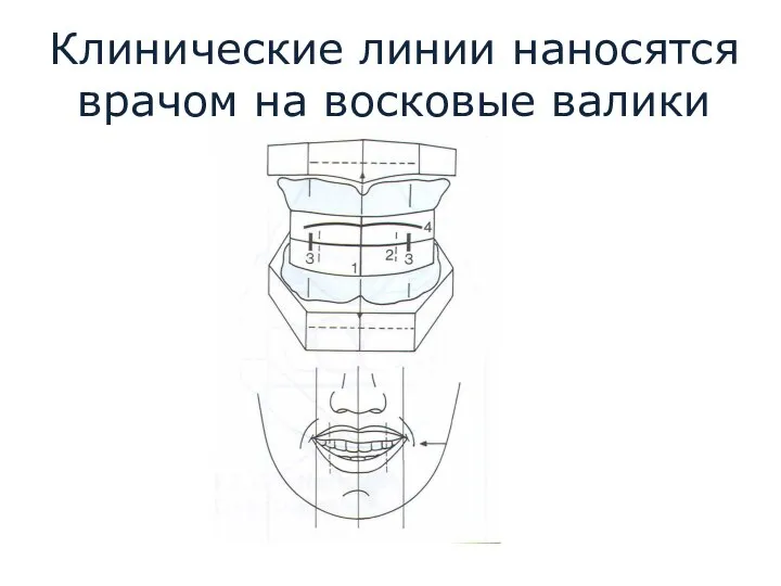 Клинические линии наносятся врачом на восковые валики