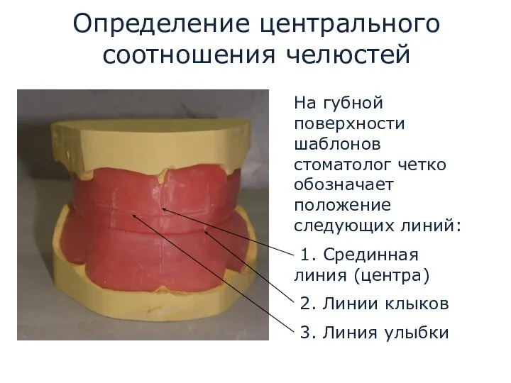 Определение центрального соотношения челюстей На губной поверхности шаблонов стоматолог четко обозначает положение