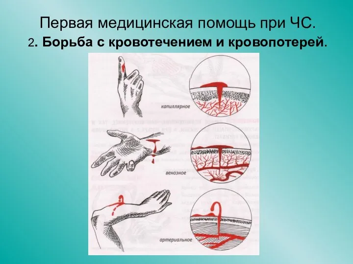 Первая медицинская помощь при ЧС. 2. Борьба с кровотечением и кровопотерей.