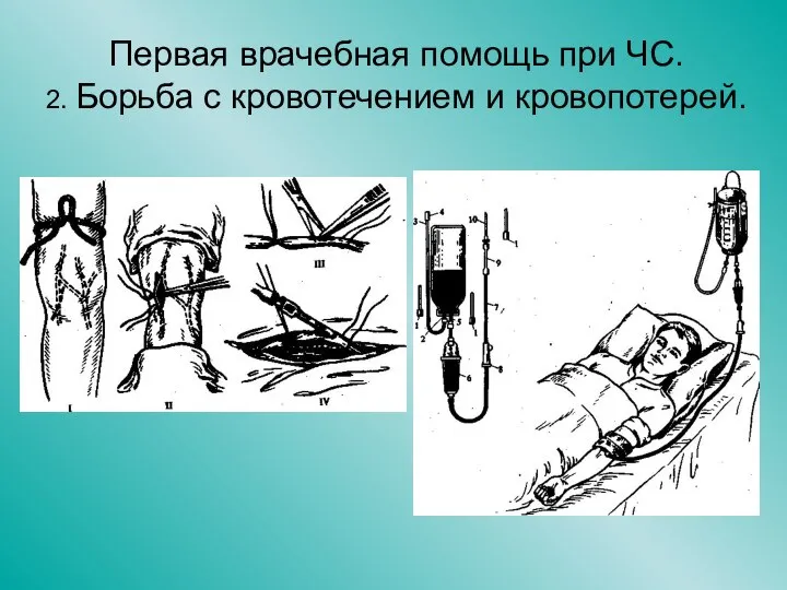 Первая врачебная помощь при ЧС. 2. Борьба с кровотечением и кровопотерей.