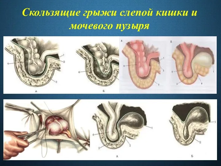 Скользящие грыжи слепой кишки и мочевого пузыря