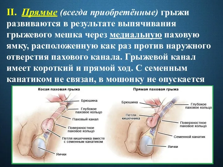 II. Прямые (всегда приобретённые) грыжи развиваются в результате выпячивания грыжевого мешка через