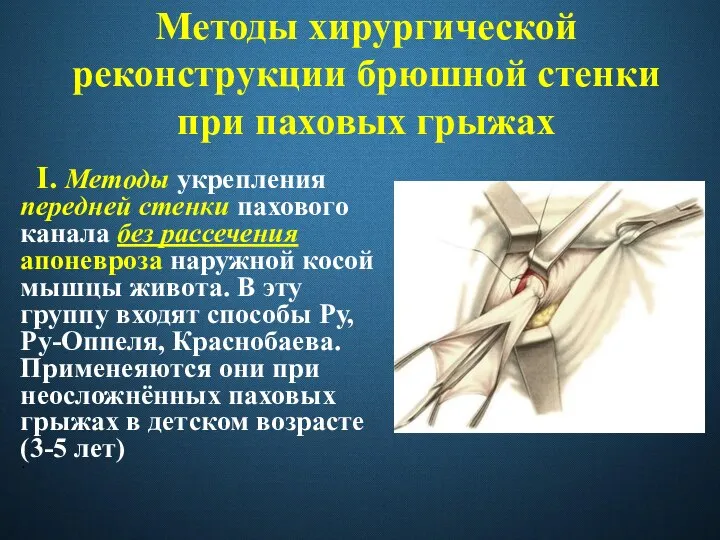 Методы хирургической реконструкции брюшной стенки при паховых грыжах I. Методы укрепления передней