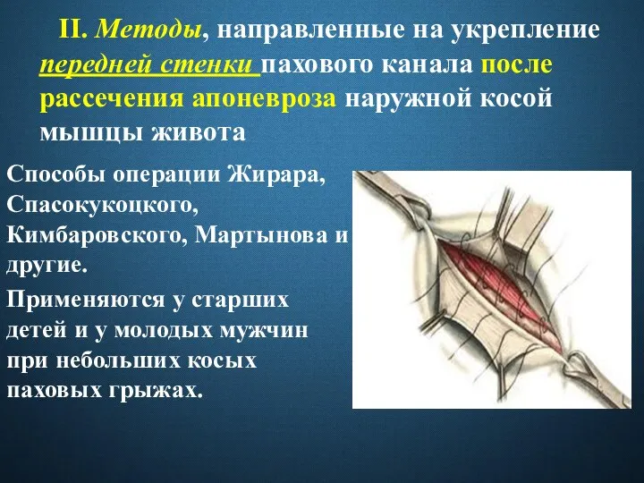 II. Методы, направленные на укрепление передней стенки пахового канала после рассечения апоневроза