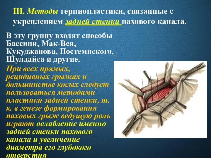 III. Методы герниопластики, связанные с укреплением задней стенки пахового канала. В эту