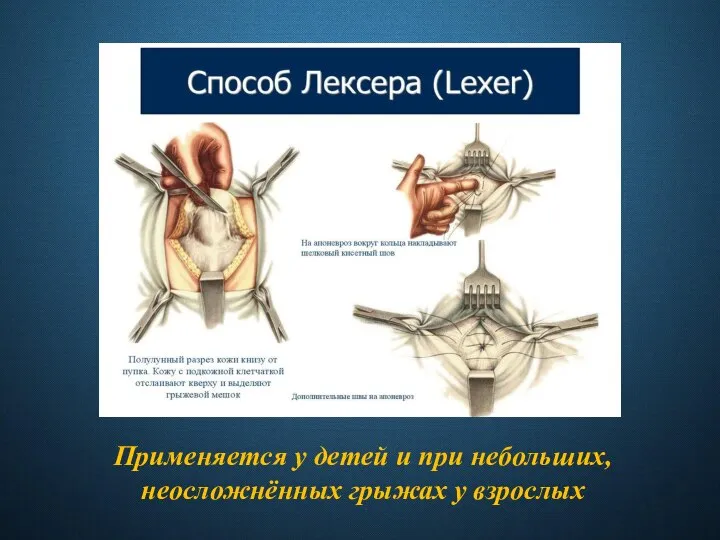 Применяется у детей и при небольших, неосложнённых грыжах у взрослых