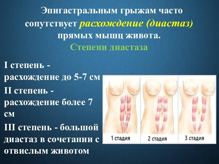 Эпигастральным грыжам часто сопутствует расхождение (диастаз) прямых мышц живота. Степени диастаза I