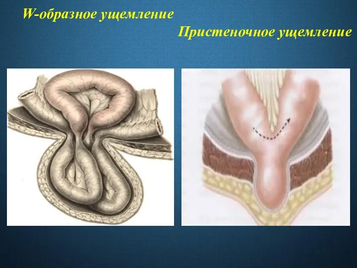 W-образное ущемление Пристеночное ущемление