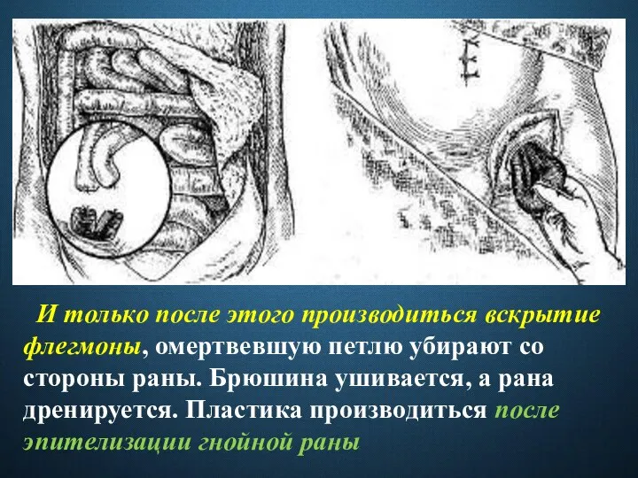 И только после этого производиться вскрытие флегмоны, омертвевшую петлю убирают со стороны