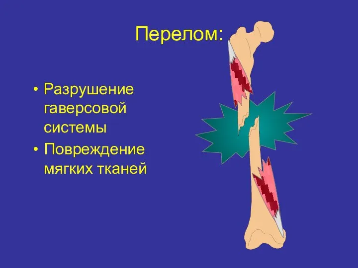 Перелом: Разрушение гаверсовой системы Повреждение мягких тканей