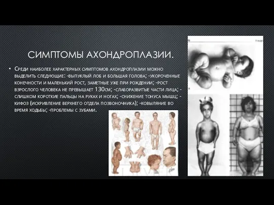 СИМПТОМЫ АХОНДРОПЛАЗИИ. Среди наиболее характерных симптомов ахондроплазии можно выделить следующие: -выпуклый лоб