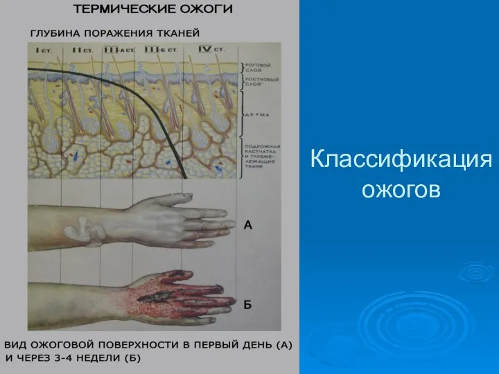 Классификация ожогов