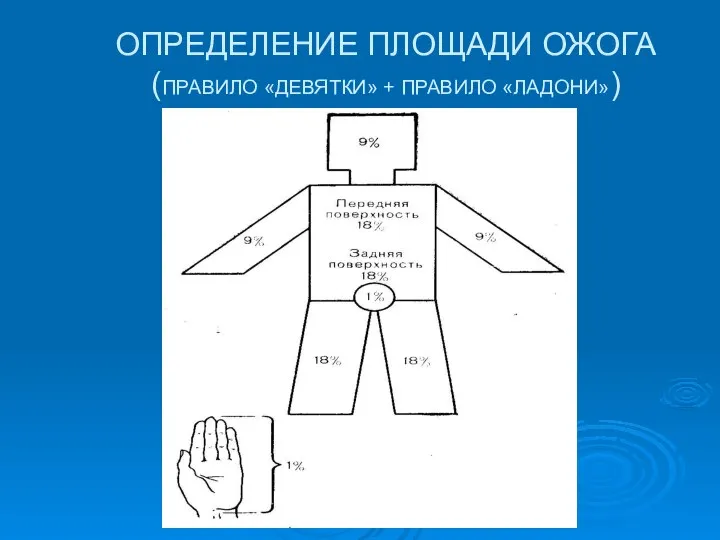 ОПРЕДЕЛЕНИЕ ПЛОЩАДИ ОЖОГА (ПРАВИЛО «ДЕВЯТКИ» + ПРАВИЛО «ЛАДОНИ»)