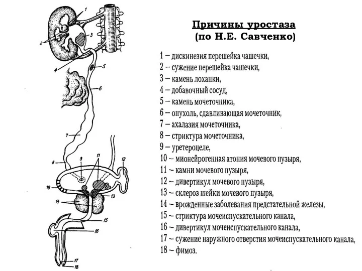 Причины уростаза (по Н.Е. Савченко)