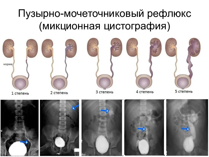 Пузырно-мочеточниковый рефлюкс (микционная цистография)