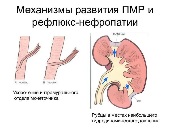 Механизмы развития ПМР и рефлюкс-нефропатии Укорочение интрамурального отдела мочеточника Рубцы в местах наибольшего гидродинамического давления