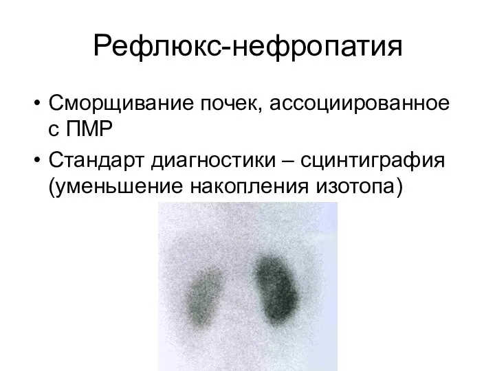 Рефлюкс-нефропатия Сморщивание почек, ассоциированное с ПМР Стандарт диагностики – сцинтиграфия (уменьшение накопления изотопа)