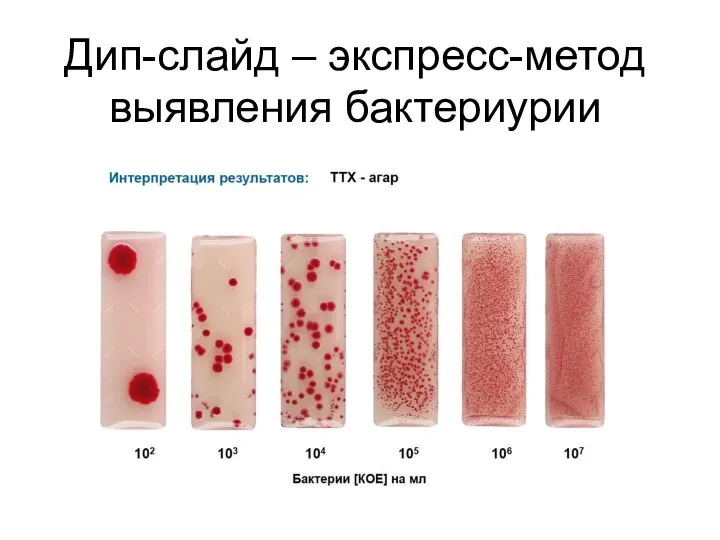 Дип-слайд – экспресс-метод выявления бактериурии