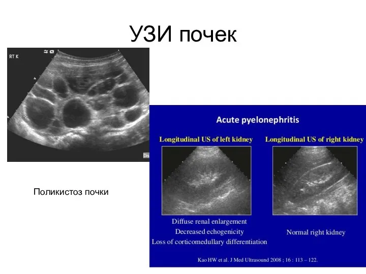 УЗИ почек Поликистоз почки