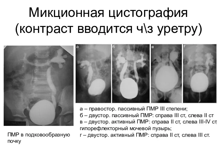 Микционная цистография (контраст вводится ч\з уретру) ПМР в подковообразную почку а –