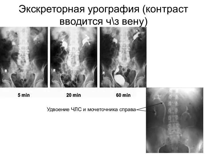 Экскреторная урография (контраст вводится ч\з вену) Удвоение ЧЛС и мочеточника справа