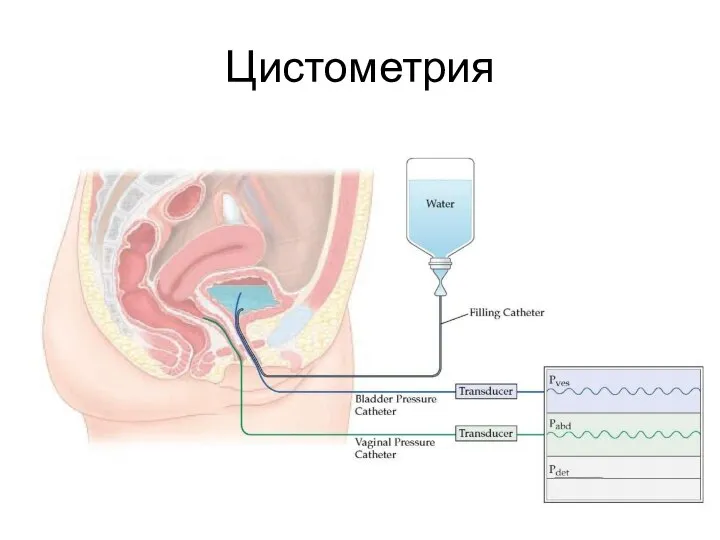 Цистометрия