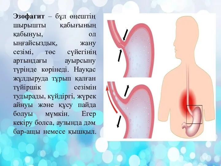 Эзофагит – бұл өңештің шырышты қабығының қабынуы, ол ыңғайсыздық, жану сезімі, төс