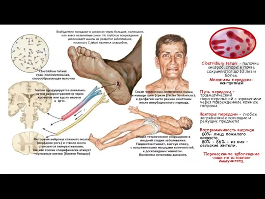 Clostridium tetani - палочка анаэроб, споры в почве сохраняются до 10 лет