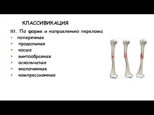 КЛАССИФИКАЦИЯ ІІІ. По форме и направлению перелома поперечные продольные косые винтообразные оскольчатые вколоченные компрессионные