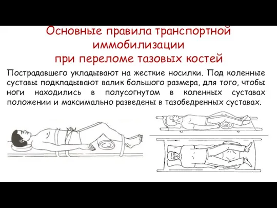 Пострадавшего укладывают на жесткие носилки. Под коленные суставы подкладывают валик большого размера,