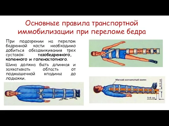 При подозрении на перелом бедренной кости необходимо добиться обездвиживания трех суставов: тазобедренного,