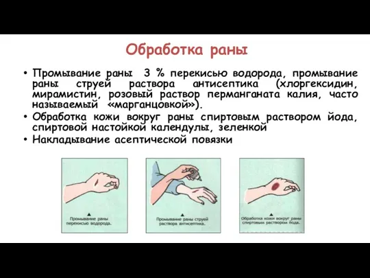 Обработка раны Промывание раны 3 % перекисью водорода, промывание раны струей раствора