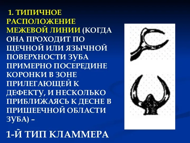 1. ТИПИЧНОЕ РАСПОЛОЖЕНИЕ МЕЖЕВОЙ ЛИНИИ (КОГДА ОНА ПРОХОДИТ ПО ЩЕЧНОЙ ИЛИ ЯЗЫЧНОЙ