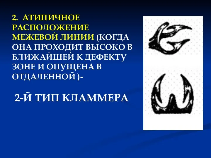 2. АТИПИЧНОЕ РАСПОЛОЖЕНИЕ МЕЖЕВОЙ ЛИНИИ (КОГДА ОНА ПРОХОДИТ ВЫСОКО В БЛИЖАЙШЕЙ К