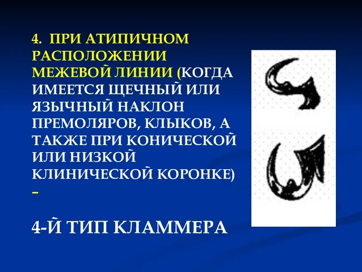 4. ПРИ АТИПИЧНОМ РАСПОЛОЖЕНИИ МЕЖЕВОЙ ЛИНИИ (КОГДА ИМЕЕТСЯ ЩЕЧНЫЙ ИЛИ ЯЗЫЧНЫЙ НАКЛОН