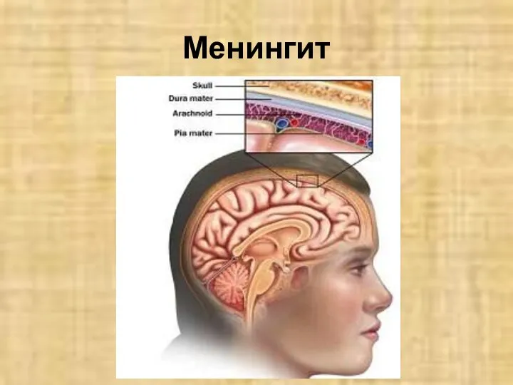 Менингит