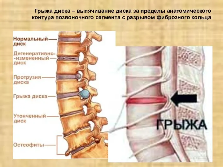 Грыжа диска – выпячивание диска за пределы анатомического контура позвоночного сегмента с разрывом фиброзного кольца