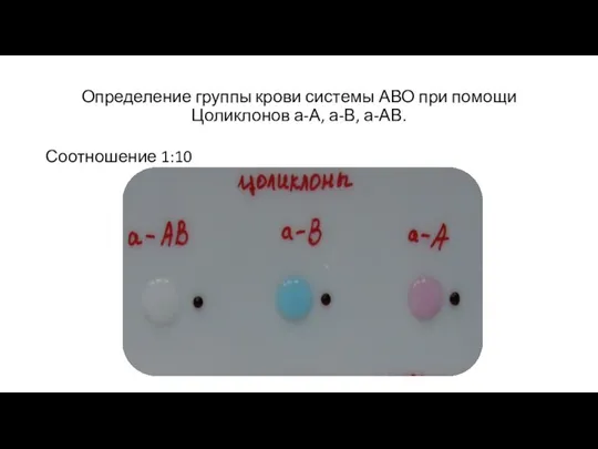 Определение группы крови системы АВО при помощи Цоликлонов а-А, а-В, а-АВ. Соотношение 1:10