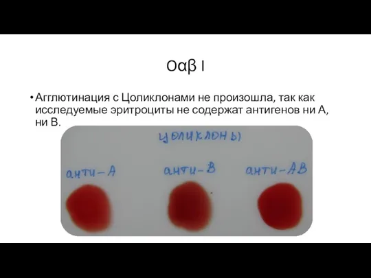 Oαβ I Агглютинация с Цоликлонами не произошла, так как исследуемые эритроциты не