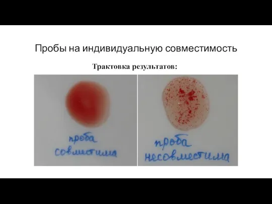 Пробы на индивидуальную совместимость Трактовка результатов: