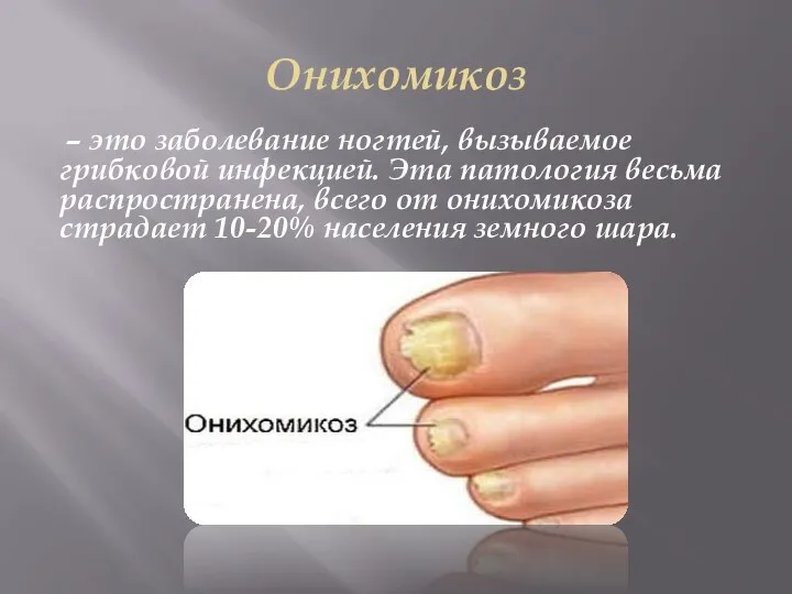 Онихомикоз – это заболевание ногтей, вызываемое грибковой инфекцией. Эта патология весьма распространена,