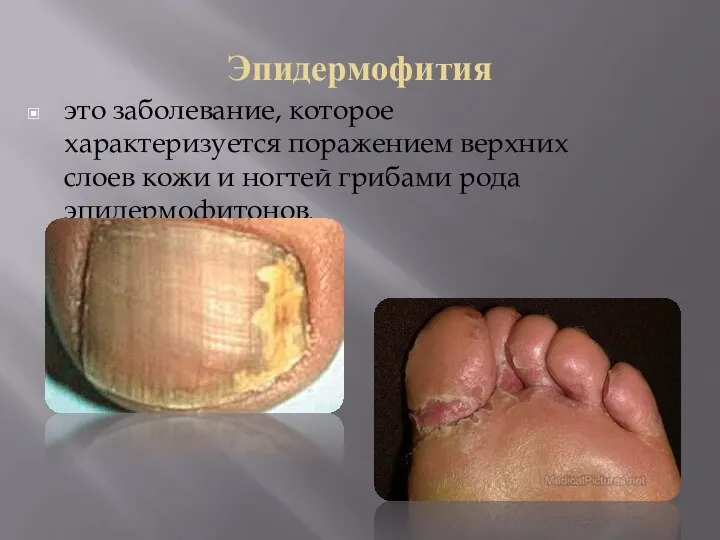 Эпидермофития это заболевание, которое характеризуется поражением верхних слоев кожи и ногтей грибами рода эпидермофитонов.