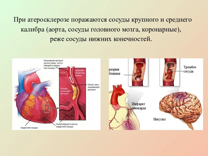 При атеросклерозе поражаются сосуды крупного и среднего калибра (аорта, сосуды головного мозга,