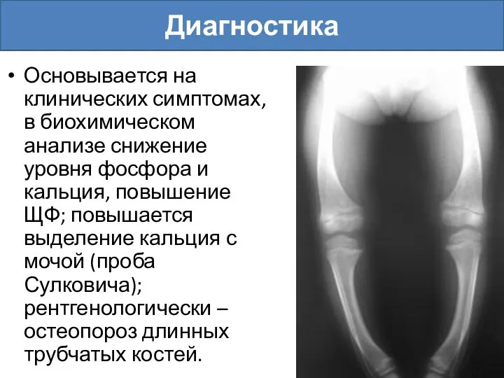 Основывается на клинических симптомах, в биохимическом анализе снижение уровня фосфора и кальция,