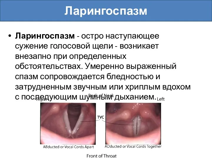 Ларингоспазм - остро наступающее сужение голосовой щели - возникает внезапно при определенных