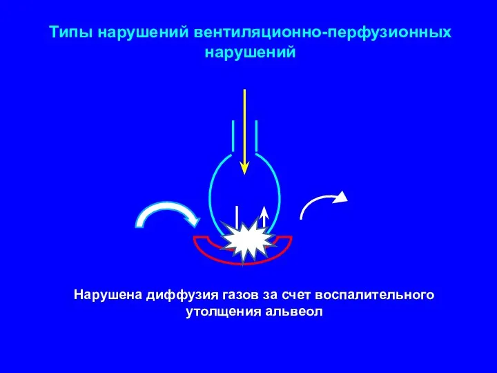 Типы нарушений вентиляционно-перфузионных нарушений Нарушена диффузия газов за счет воспалительного утолщения альвеол