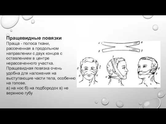 Пращевидные повязки Праща - полоса ткани, рассеченная в продольном направлении с двух