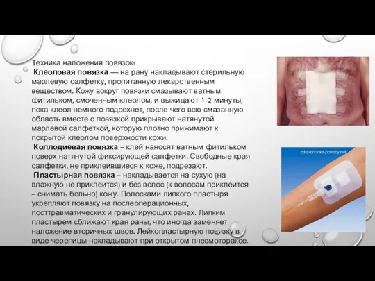 Техника наложения повязок: Клеоловая повязка — на рану накладывают стерильную марлевую салфетку,