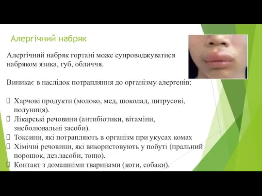 Алергічний набряк Алергічний набряк гортані може супроводжуватися набряком язика, губ, обличчя. Виникає